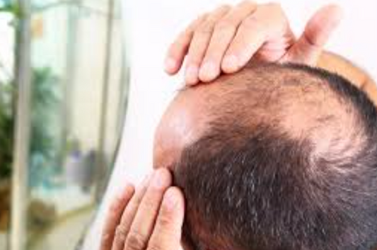 What Is Male Pattern Baldness?